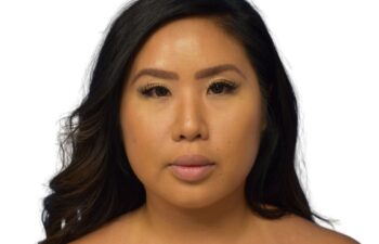 After submental liposuction, front view of a female patient treated by Dr. Benjamin Eskenazi at Avabello Aesthetics.