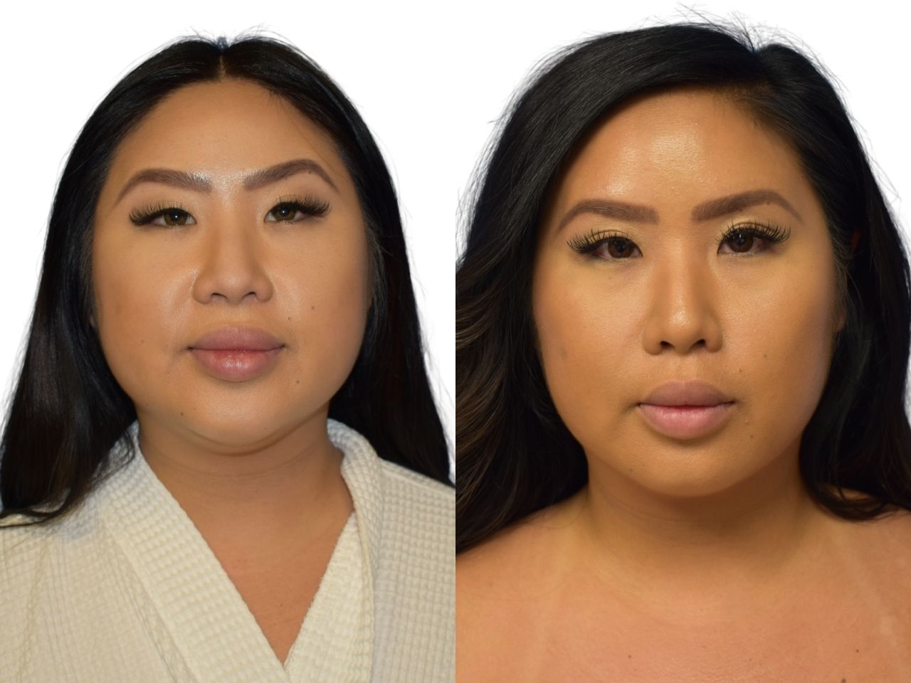 Before and after submental liposuction, front view of a female patient treated by Dr. Benjamin Eskenazi at Avabello Aesthetics.