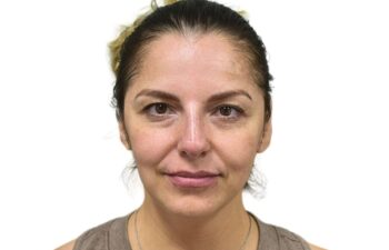 After liquid rhinoplasty treatment, front view of a female patient treated by Dr. Benjamin Eskenazi at Avabello Aesthetics in Miami Beach.