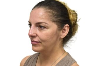 After liquid rhinoplasty treatment, left oblique view of a female patient treated by Dr. Benjamin Eskenazi at Avabello Aesthetics in Miami Beach.