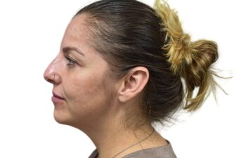 After liquid rhinoplasty treatment, left view of a female patient treated by Dr. Benjamin Eskenazi at Avabello Aesthetics in Miami Beach.