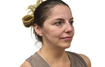 After liquid rhinoplasty treatment, right oblique view of a female patient treated by Dr. Benjamin Eskenazi at Avabello Aesthetics in Miami Beach.