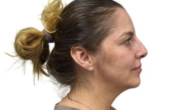 After liquid rhinoplasty treatment, right view of a female patient treated by Dr. Benjamin Eskenazi at Avabello Aesthetics in Miami Beach.