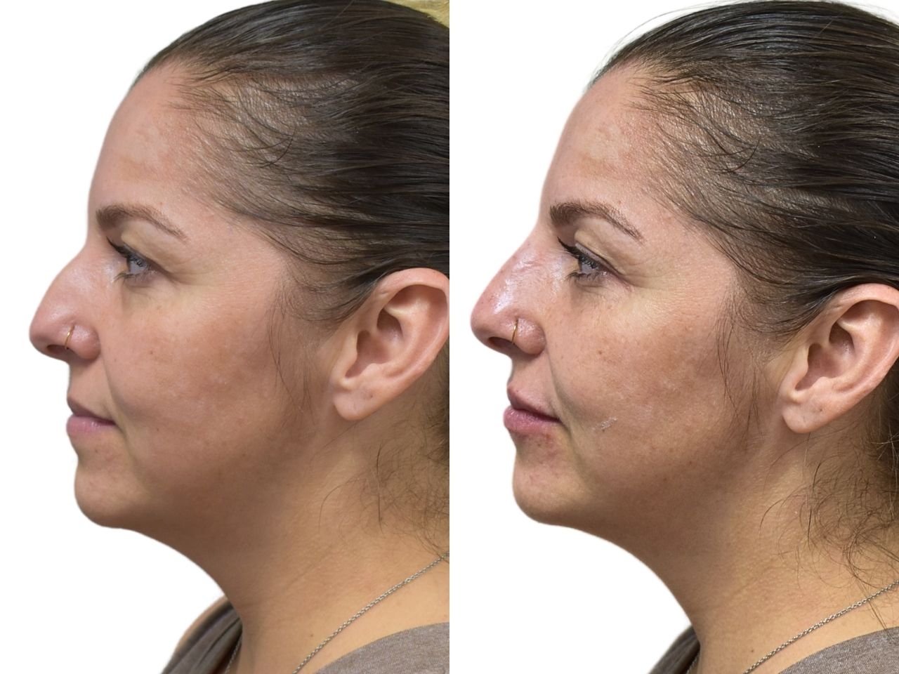 Before and after liquid rhinoplasty treatment, left view of a female patient treated by Dr. Benjamin Eskenazi at Avabello Aesthetics in Miami Beach.