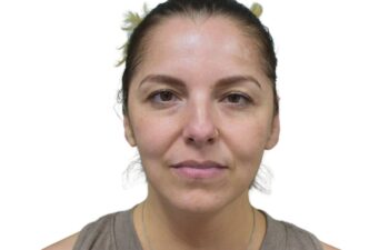 Before liquid rhinoplasty treatment, front view of a female patient treated by Dr. Benjamin Eskenazi at Avabello Aesthetics in Miami Beach.