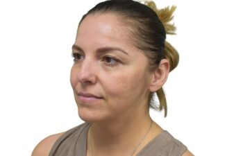 Before liquid rhinoplasty treatment, left oblique view of a female patient treated by Dr. Benjamin Eskenazi at Avabello Aesthetics in Miami Beach.