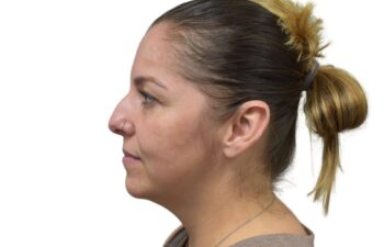 Before liquid rhinoplasty treatment, left view of a female patient treated by Dr. Benjamin Eskenazi at Avabello Aesthetics in Miami Beach.