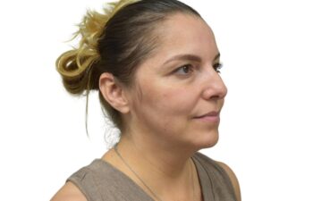 Before liquid rhinoplasty treatment, right oblique view of a female patient treated by Dr. Benjamin Eskenazi at Avabello Aesthetics in Miami Beach.