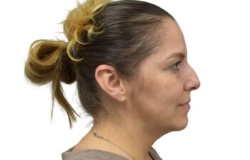 Before liquid rhinoplasty treatment, right view of a female patient treated by Dr. Benjamin Eskenazi at Avabello Aesthetics in Miami Beach.