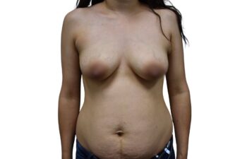 Before Mommy Makeover, front view of a female patient treated by Dr. Benjamin Eskenazi at Avabello Aesthetics in Miami Beach.