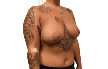 After tuberous breast correction, right oblique view of a female patient treated by Dr. Benjamin Eskenazi at Avabello Aesthetics.