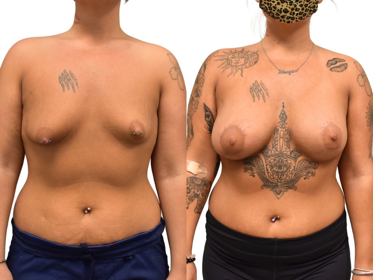 Before and After tuberous breast correction, front view of a female patient treated by Dr. Benjamin Eskenazi at Avabello Aesthetics.