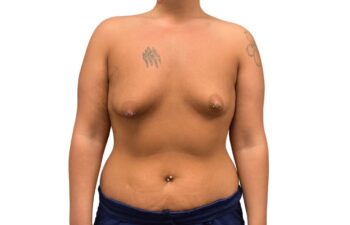 Before tuberous breast correction, front view of a female patient treated by Dr. Benjamin Eskenazi at Avabello Aesthetics.