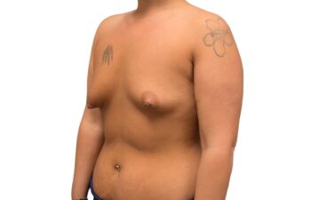 Before tuberous breast correction, left oblique view of a female patient treated by Dr. Benjamin Eskenazi at Avabello Aesthetics.