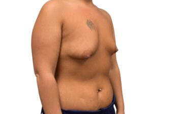 Before tuberous breast correction, right oblique view of a female patient treated by Dr. Benjamin Eskenazi at Avabello Aesthetics.