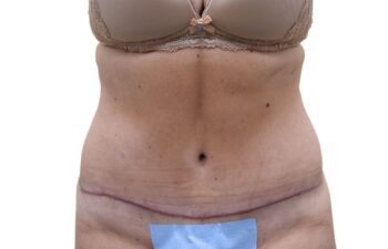 After tummy tuck, front view of a female patient treated by Dr. Benjamin Eskenazi at Avabello Aesthetics in Miami Beach.