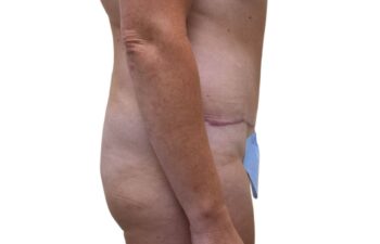 After tummy tuck, right view of a female patient treated by Dr. Benjamin Eskenazi at Avabello Aesthetics in Miami Beach.