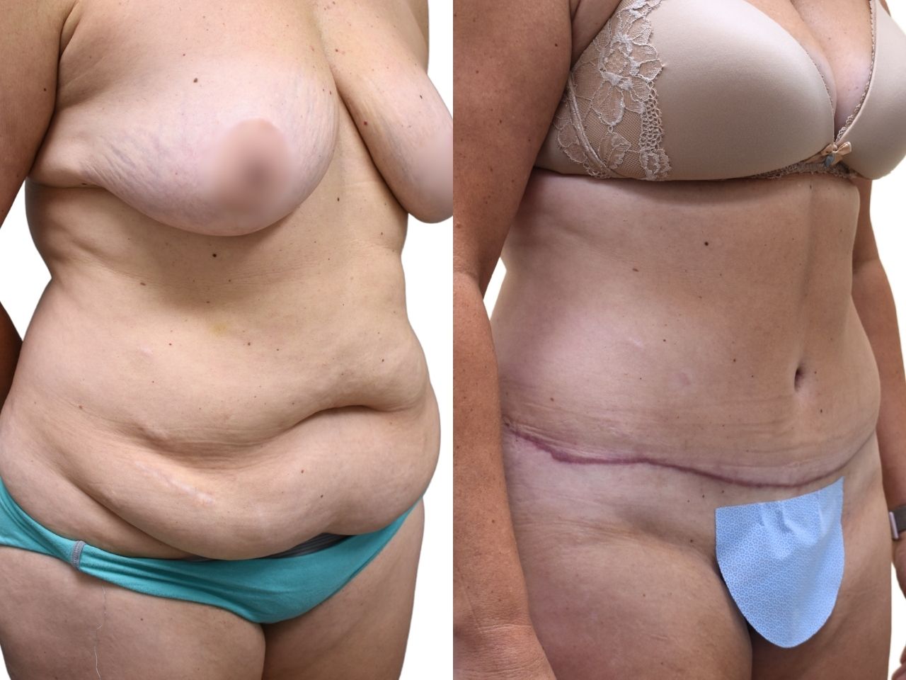 Before and after tummy tuck, right oblique view of a female patient treated by Dr. Benjamin Eskenazi at Avabello Aesthetics in Miami Beach.