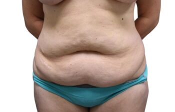 Before tummy tuck, front view of a female patient treated by Dr. Benjamin Eskenazi at Avabello Aesthetics in Miami Beach.