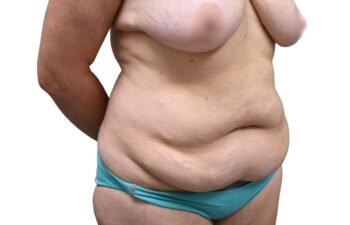 Before tummy tuck, right oblique view of a female patient treated by Dr. Benjamin Eskenazi at Avabello Aesthetics in Miami Beach.