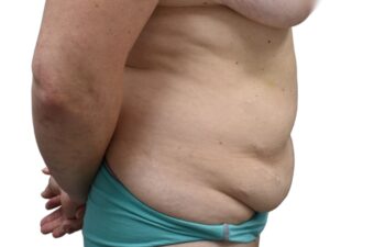 Before tummy tuck, right view of a female patient treated by Dr. Benjamin Eskenazi at Avabello Aesthetics in Miami Beach.