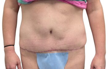 After tummy tuck, front view of a female patient treated by Dr. Benjamin Eskenazi at Avabello Aesthetics in Miami Beach.