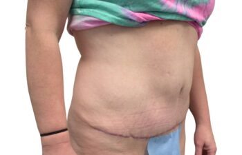 After tummy tuck, right oblique view of a female patient treated by Dr. Benjamin Eskenazi at Avabello Aesthetics in Miami Beach.