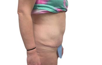 After tummy tuck, right view of a female patient treated by Dr. Benjamin Eskenazi at Avabello Aesthetics in Miami Beach.