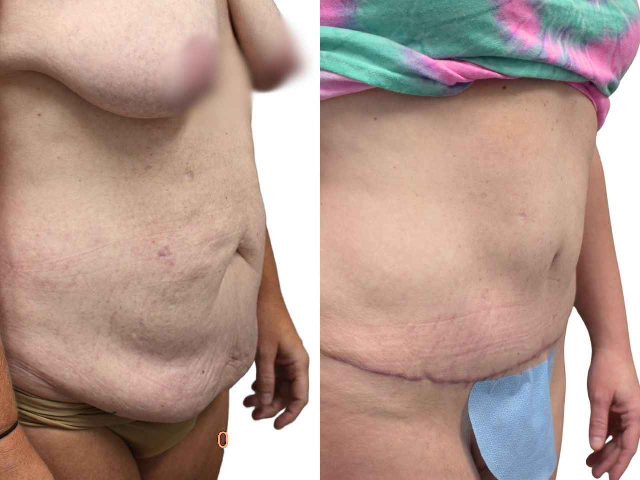 Before and after tummy tuck, right oblique view of a female patient treated by Dr. Benjamin Eskenazi at Avabello Aesthetics in Miami Beach.