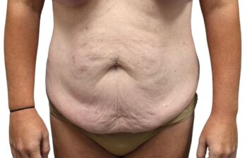 Before tummy tuck, front view of a female patient treated by Dr. Benjamin Eskenazi at Avabello Aesthetics in Miami Beach.