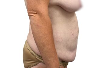 Before tummy tuck, right view of a female patient treated by Dr. Benjamin Eskenazi at Avabello Aesthetics in Miami Beach.