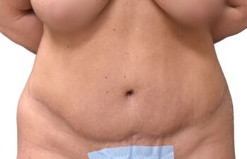 After tummy tuck, front view of a female patient treated by Dr. Benjamin Eskenazi at Avabello Aesthetics in Miami Beach.
