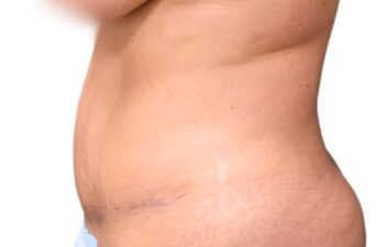 After tummy tuck, left view of a female patient treated by Dr. Benjamin Eskenazi at Avabello Aesthetics in Miami Beach.