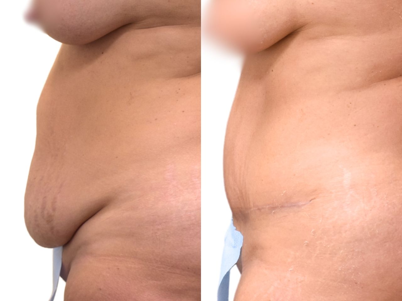 Before and after tummy tuck, right oblique view of a female patient treated by Dr. Benjamin Eskenazi at Avabello Aesthetics in Miami Beach.