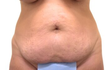 Before tummy tuck, front view of a female patient treated by Dr. Benjamin Eskenazi at Avabello Aesthetics in Miami Beach.