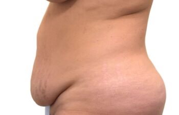 Before tummy tuck, left view of a female patient treated by Dr. Benjamin Eskenazi at Avabello Aesthetics in Miami Beach.