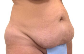 Before tummy tuck, right view of a female patient treated by Dr. Benjamin Eskenazi at Avabello Aesthetics in Miami Beach.