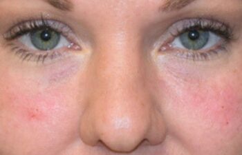 After undereye filler treatment, front view of a female patient treated by Dr. Benjamin Eskenazi at Avabello Aesthetics in Miami Beach.