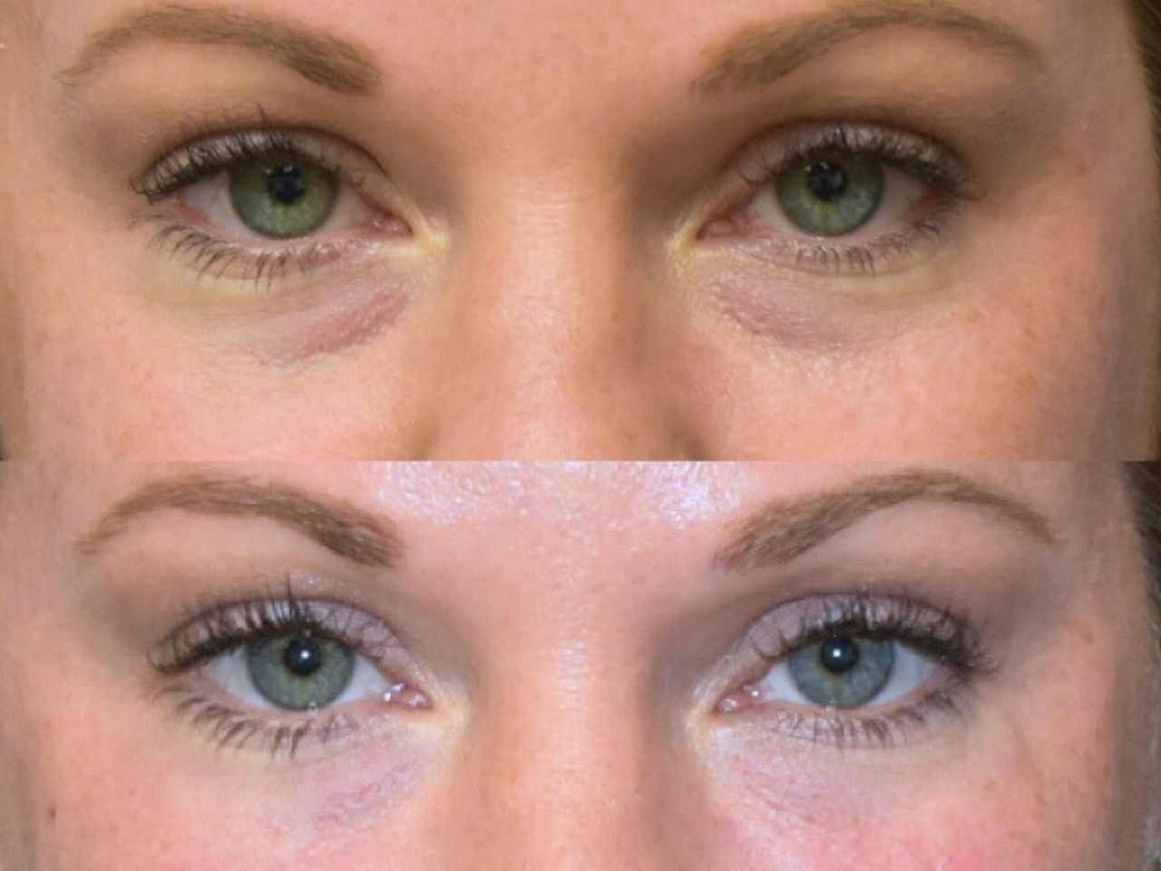 Before and after undereye filler treatment, front view of a female patient treated by Dr. Benjamin Eskenazi at Avabello Aesthetics in Miami Beach.