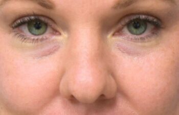 Before undereye filler treatment, front view of a female patient treated by Dr. Benjamin Eskenazi at Avabello Aesthetics in Miami Beach.