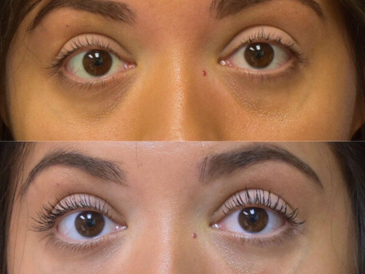 Before and after undereye filler treatment, front view of a female patient treated by Dr. Benjamin Eskenazi at Avabello Aesthetics in Miami Beach.