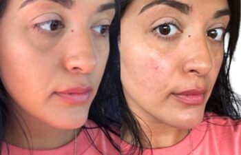 Before and after undereye filler treatment, right oblique view of a female patient treated by Dr. Benjamin Eskenazi at Avabello Aesthetics in Miami Beach.