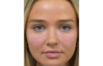 After undereye filler treatment, front view of a female patient treated by Dr. Benjamin Eskenazi at Avabello Aesthetics in Miami Beach.