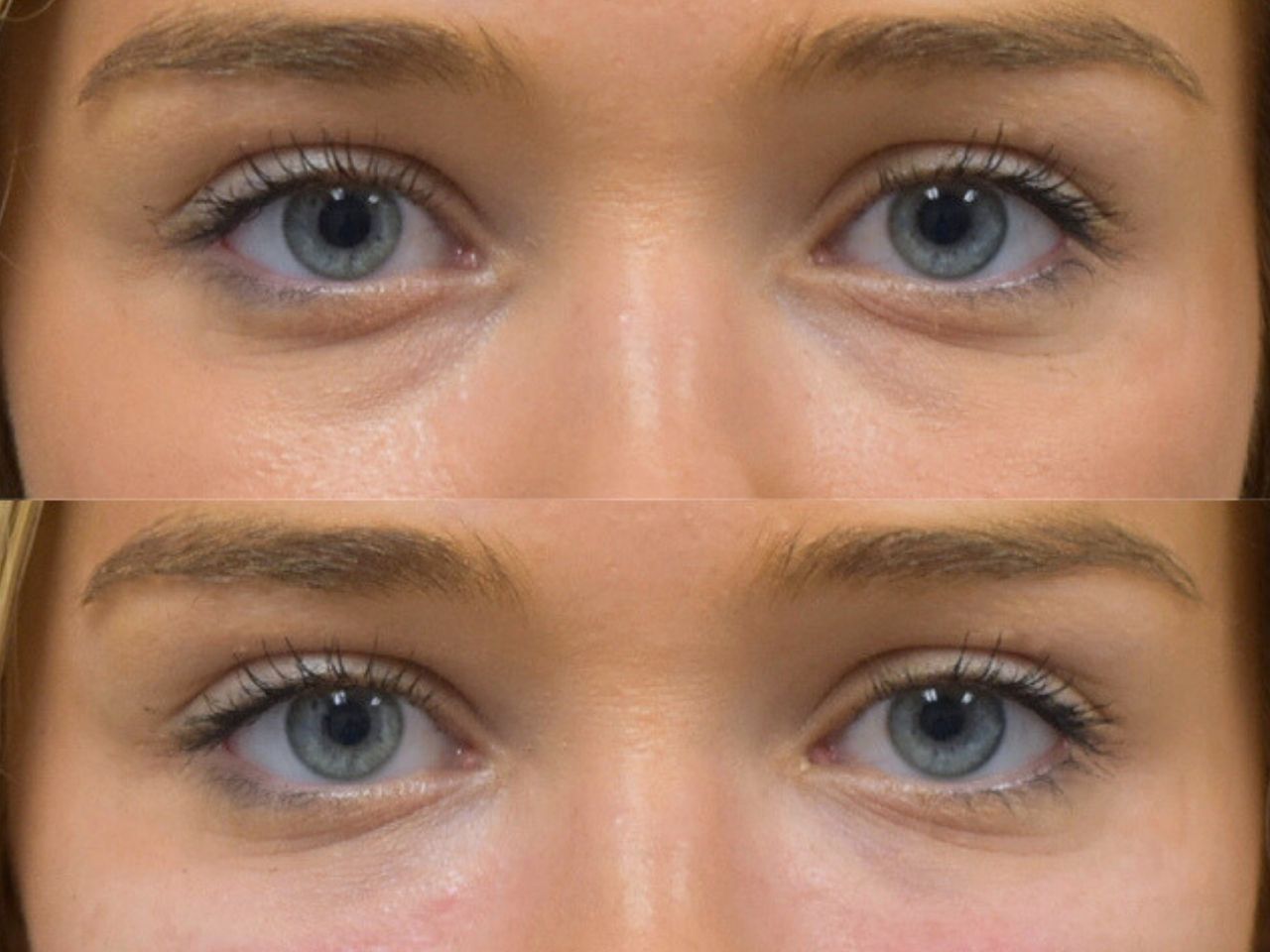 Before and after undereye filler treatment, front view of a female patient treated by Dr. Benjamin Eskenazi at Avabello Aesthetics in Miami Beach.