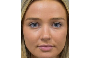 Before undereye filler treatment, front view of a female patient treated by Dr. Benjamin Eskenazi at Avabello Aesthetics in Miami Beach.