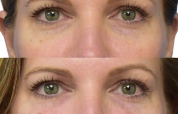 Before and after undereye filler treatment, front view of a female patient treated by Dr. Benjamin Eskenazi at Avabello Aesthetics in Miami Beach.