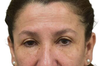 After upper and lower blepharoplasty, front view of a female patient treated by Dr. Benjamin Eskenazi at Avabello Aesthetics in Miami Beach.