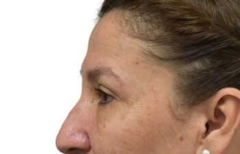 After upper and lower blepharoplasty, left view of a female patient treated by Dr. Benjamin Eskenazi at Avabello Aesthetics in Miami Beach.