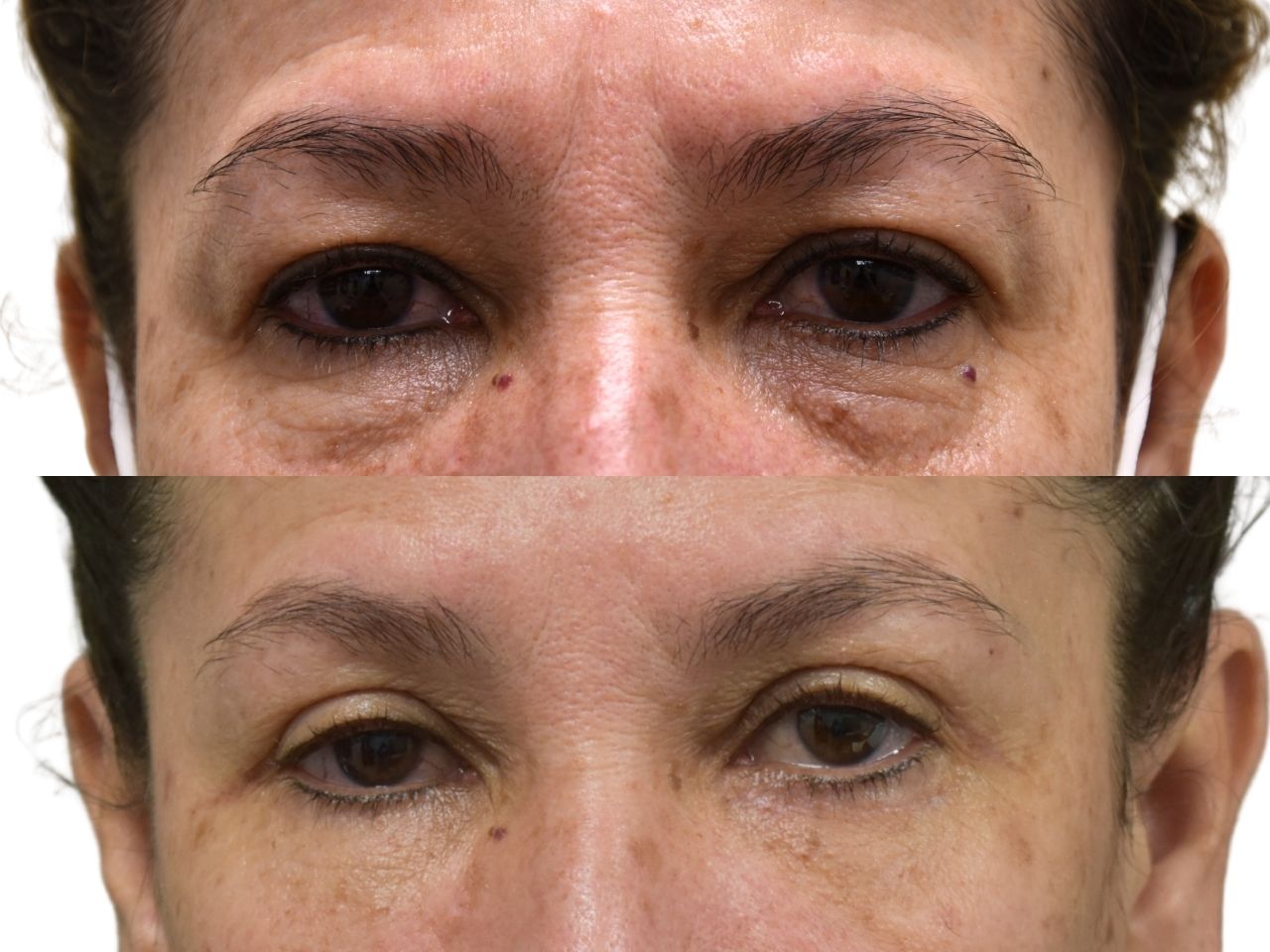 Before and after upper and lower blepharoplasty, front view of a female patient treated by Dr. Benjamin Eskenazi at Avabello Aesthetics in Miami Beach.
