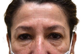Before upper and lower blepharoplasty, front view of a female patient treated by Dr. Benjamin Eskenazi at Avabello Aesthetics in Miami Beach.